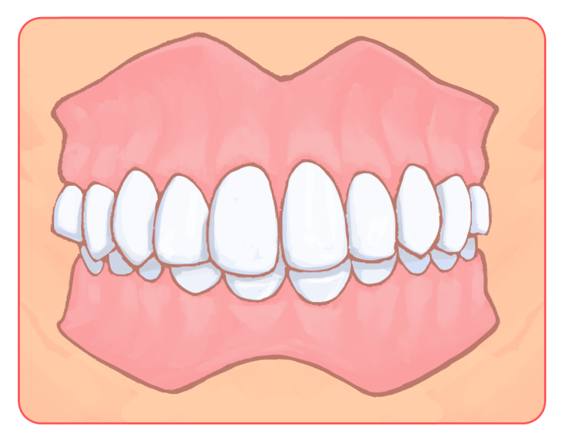 過蓋咬合（過蓋咬合）
