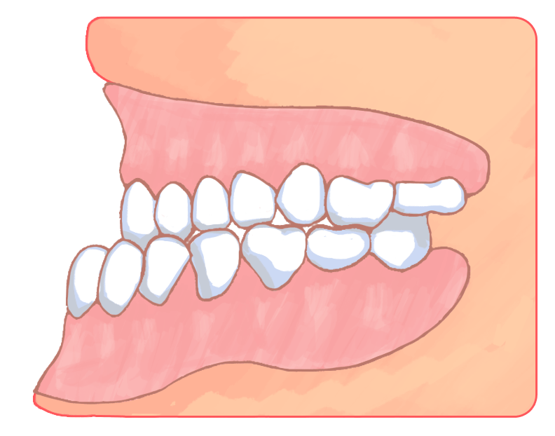 下顎前突（受け口）