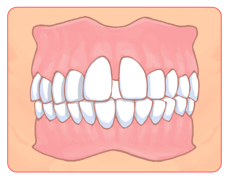 空隙歯列弓（すきっ歯）