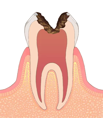 歯の内部までむし歯菌が侵入し、歯の神経や根っこを破壊している状態です。 重度のむし歯の症状としては、以下のようなものがあります。